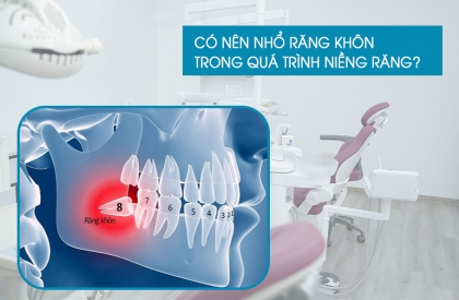 Có Nên Nhổ Răng Khôn Khi Niềng Răng? Bí Quyết Từ Chuyên Gia Nha Khoa!